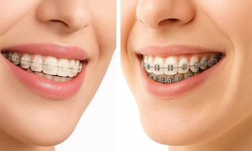 Braces treatment